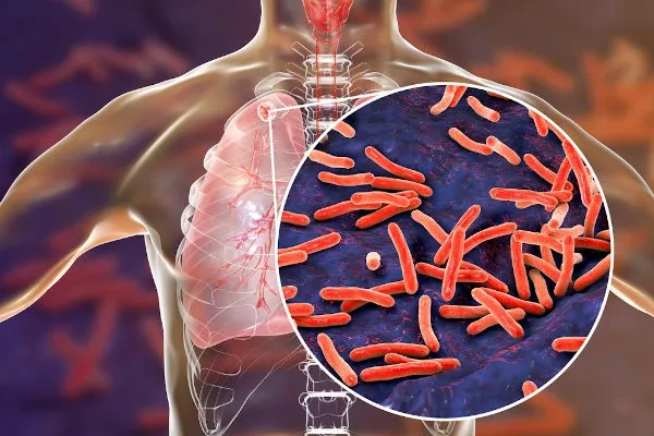 Piauí registra 1.158 casos de tuberculose em 2025 e Sesapi promove simpósio para fortalecer ações de controle